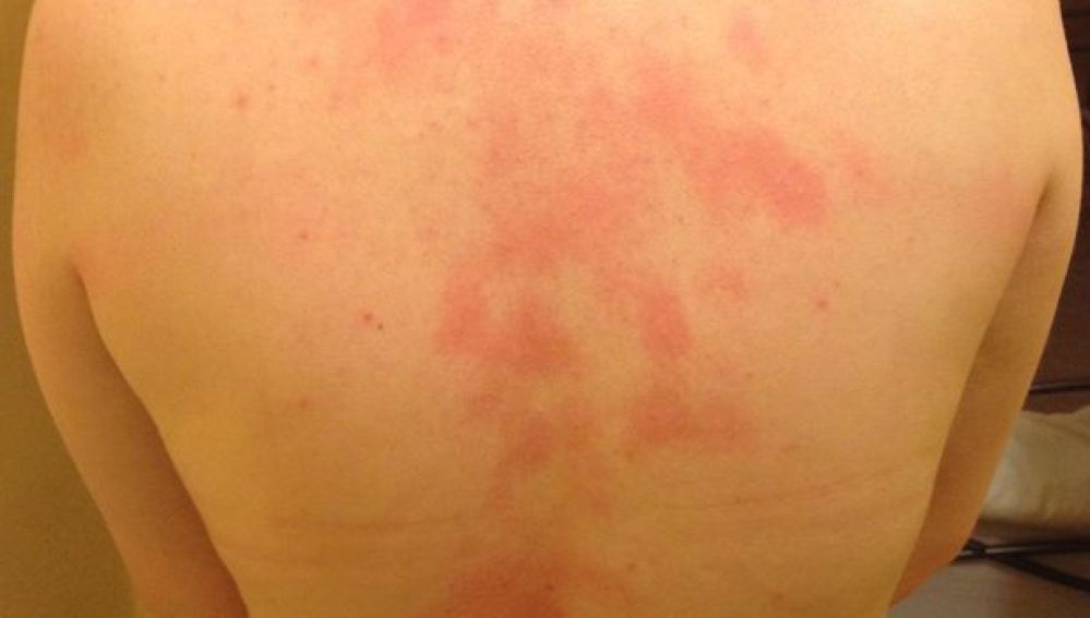 La espalda de Kerrie, tras entrar en contacto con agua