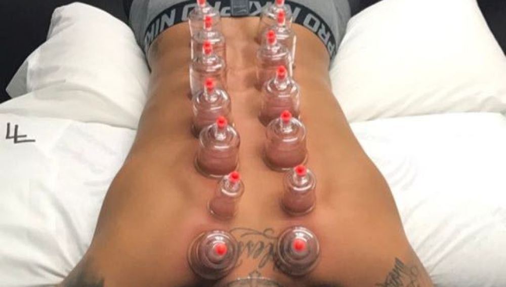 Neymar recibiendo el método del 'Cupping'