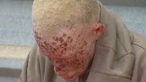 Los problemas de ser albino Los problemas de ser albino