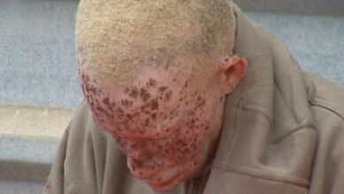 El peligro de ser albino en África