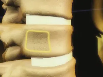 Osteoporosis Osteoporosis