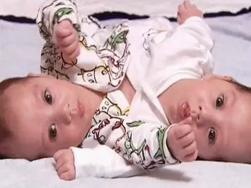 Siameses separados con éxito Siameses separados con éxito