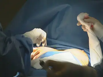 Prótesis mamarias Prótesis mamarias