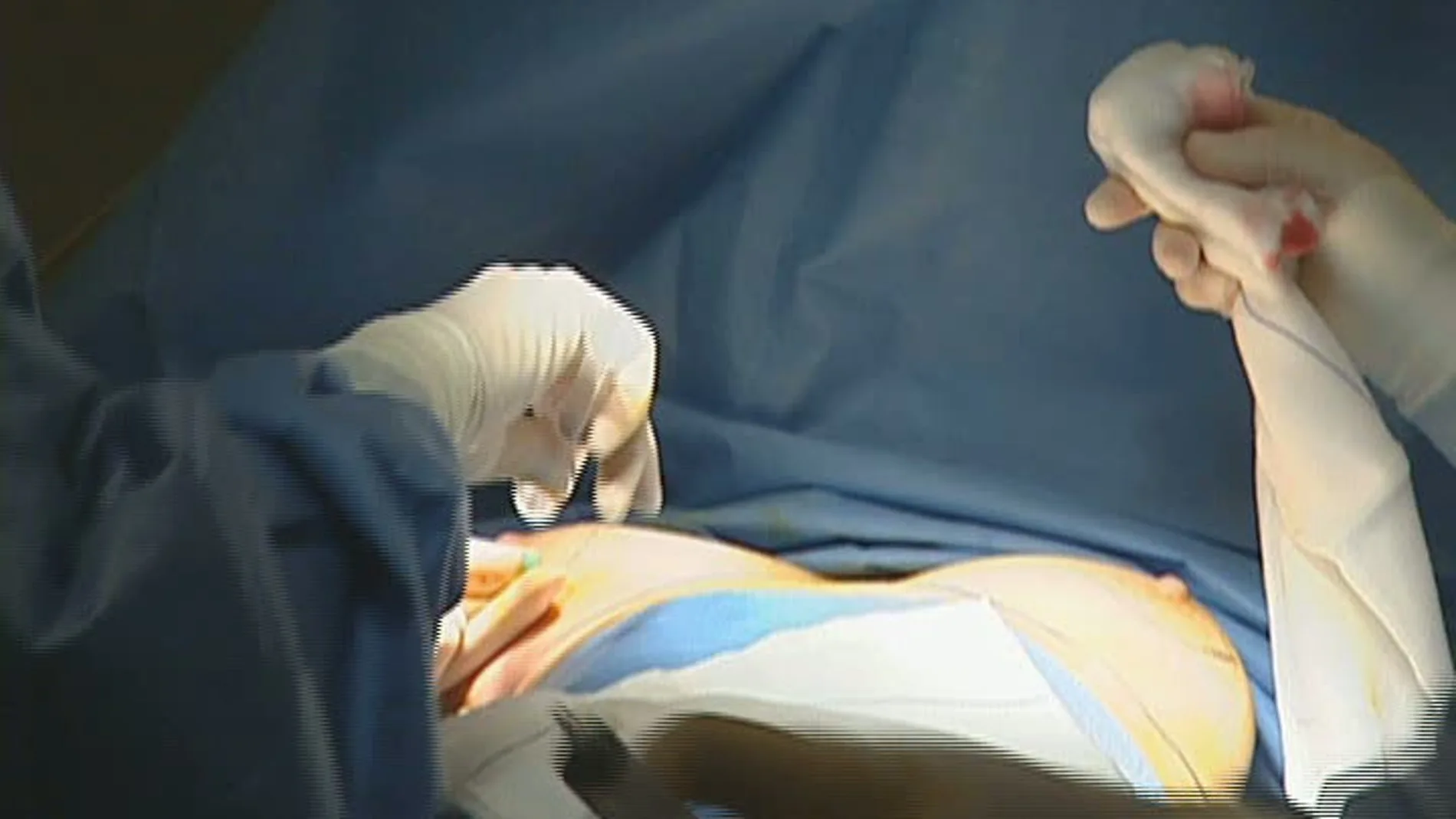 Prótesis mamarias Prótesis mamarias