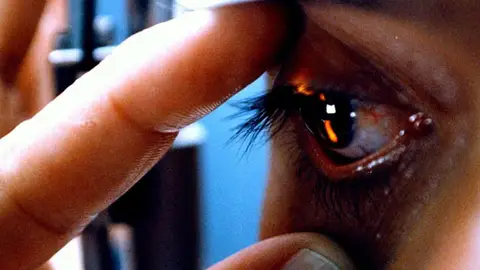 Corneas artificiales Corneas artificiales