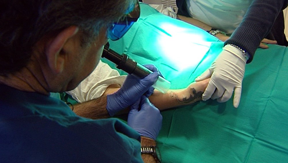 Láser para eliminar tatuajes