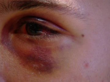 Brutal paliza a unos estudiantes en Las Palmas de Gran Canaria