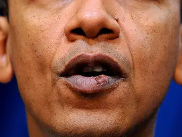 Labio de Obama herido cuando jugaba al baloncesto Labio de Obama herido cuando jugaba al baloncesto