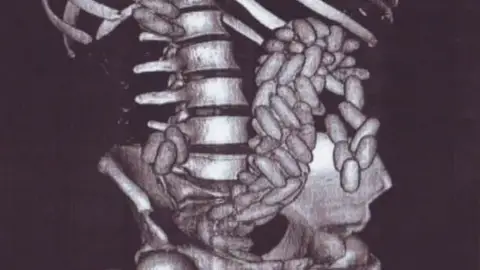 Llega al hospital con cien bolas de hachís en el estómago Llega al hospital con cien bolas de hachís en el estómago