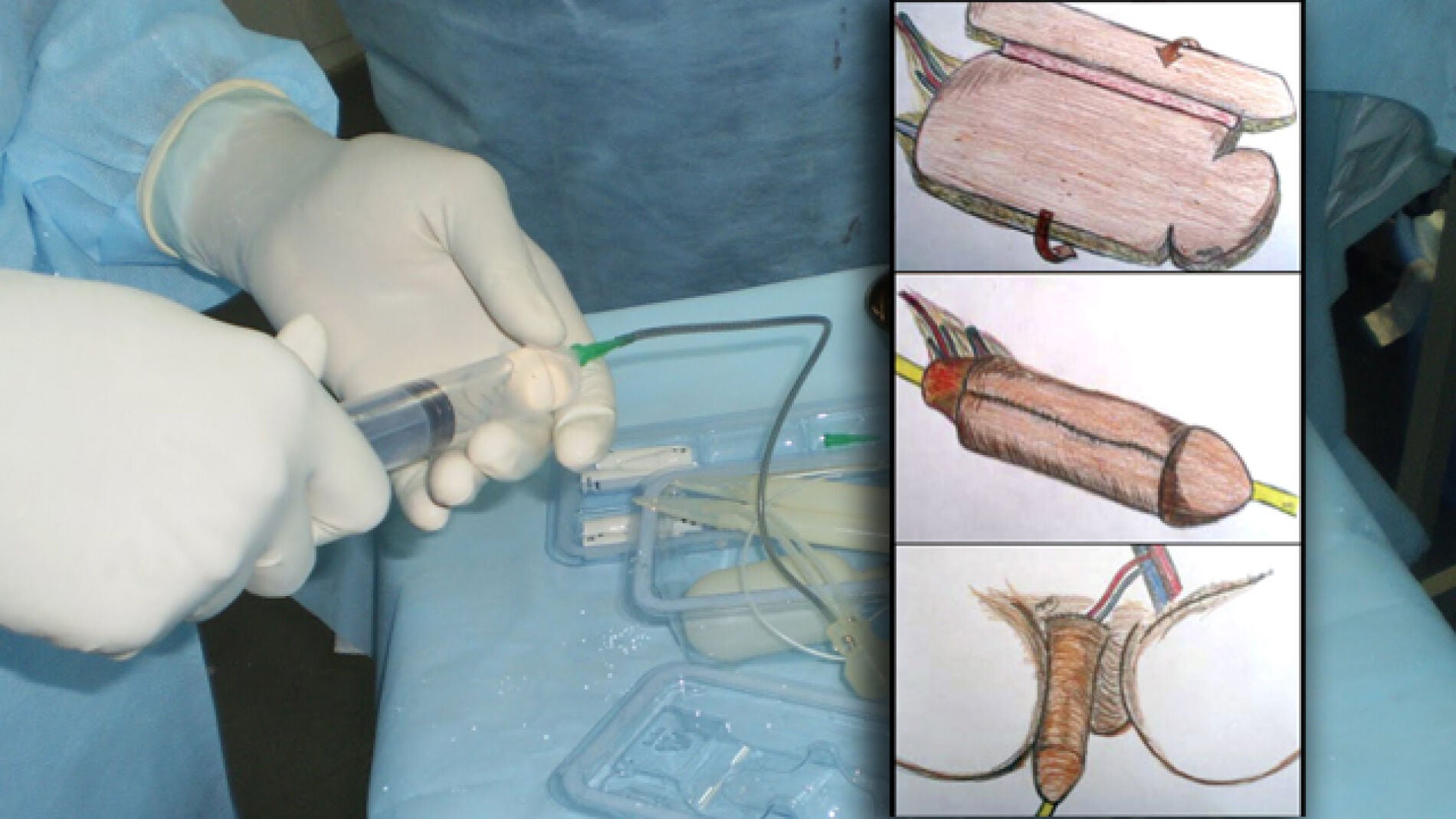 Ilustraci&oacute;n de la operaci&oacute;n de pene