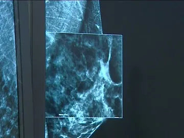 La mamografía en 3D llega a Zaragoza para avanzar en la detección del cáncer La mamografía en 3D llega a Zaragoza para avanzar en la detección del cáncer