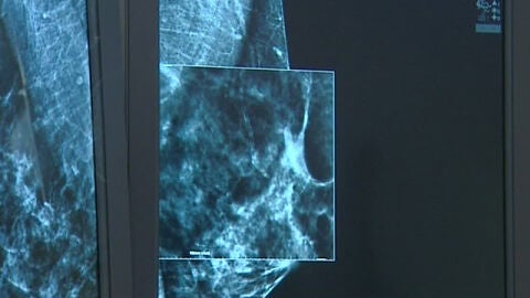 La mamograf&iacute;a en 3D llega a Zaragoza para avanzar en la detecci&oacute;n del c&aacute;ncer