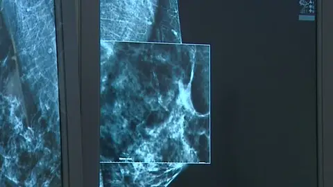 La mamografía en 3D llega a Zaragoza para avanzar en la detección del cáncer La mamografía en 3D llega a Zaragoza para avanzar en la detección del cáncer