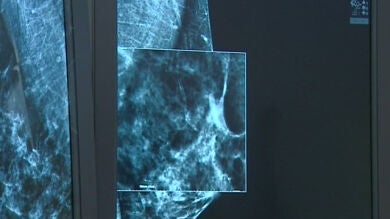 La mamografía en tres dimensiones, un gran avance en la detección del cáncer de mama