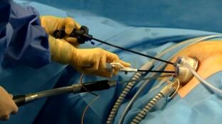 Cirug&iacute;a m&iacute;nima invasiva para extirpar un tumor