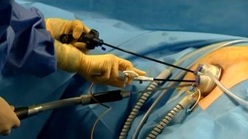 Cirugía mínima invasiva para extirpar un tumor