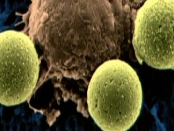 Primer éxito de un tratamiento experimental contra la leucemia 