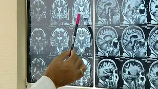 Radiografías del cerebro