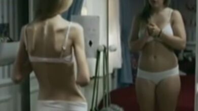 Un juez determina que una mujer con anorexia y de 31 kilos puede rechazar la alimentación forzosa 