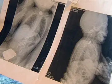 Denuncia al hospital por no detectar la pila que se ha tragado su bebé Denuncia al hospital por no detectar la pila que se ha tragado su bebé