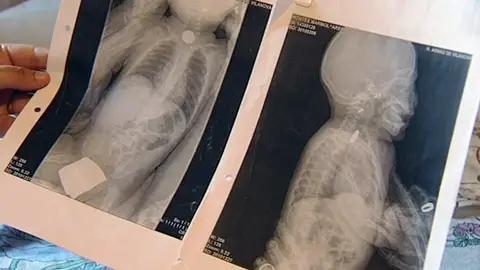 Denuncia al hospital por no detectar la pila que se ha tragado su bebé Denuncia al hospital por no detectar la pila que se ha tragado su bebé