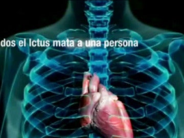 El ictus es la principal causa de muerte en nuestro país. El ictus es la principal causa de muerte en nuestro país.