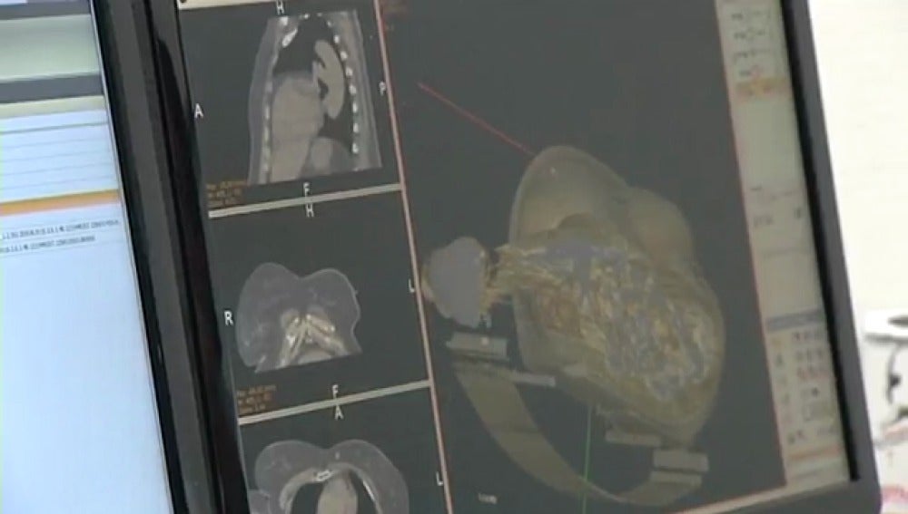 Se presenta el primer simulador de cirugía virtual de cáncer