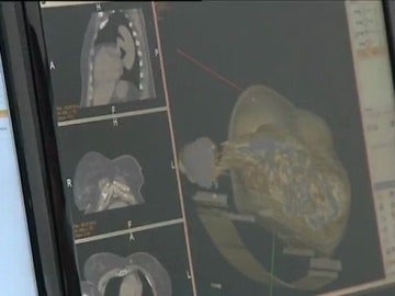 Se presenta el primer simulador de cirugía virtual de cáncer