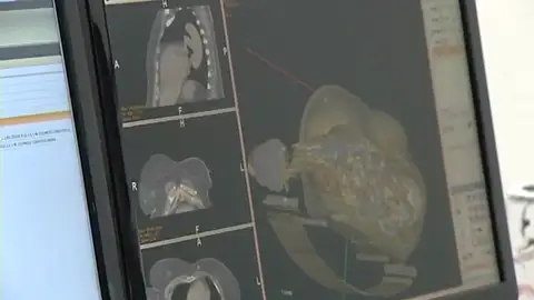 Se presenta el primer simulador de cirugía virtual de cáncer Se presenta el primer simulador de cirugía virtual de cáncer