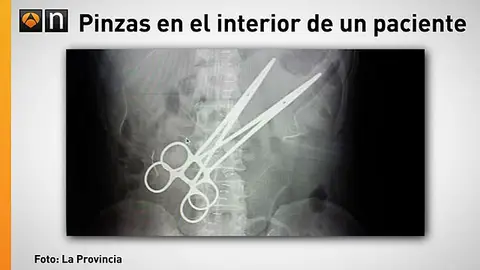 Radiografia de un chino con dos pinzas en su abdomen Radiografia de un chino con dos pinzas en su abdomen