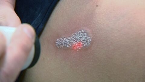 Comienza la moda de quitarse los tatuajes