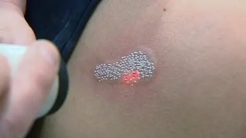 Comienza la moda de quitarse los tatuajes Comienza la moda de quitarse los tatuajes