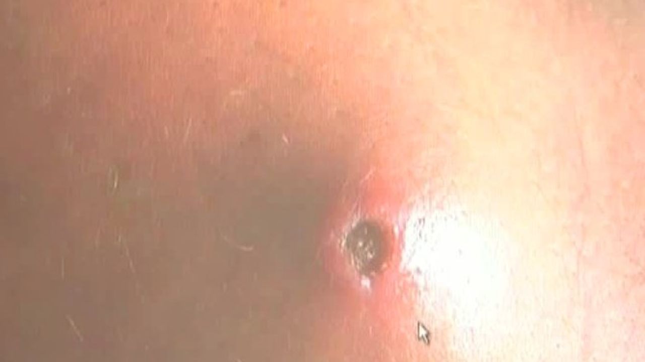 sintomas de gusanos en la piel