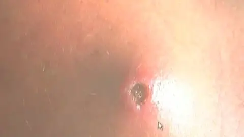 Un hospital madrileño halla el primer caso en el mundo de miasis en humanos Un hospital madrileño halla el primer caso en el mundo de miasis en humanos