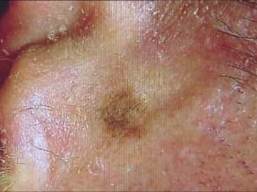 Melanoma Melanoma