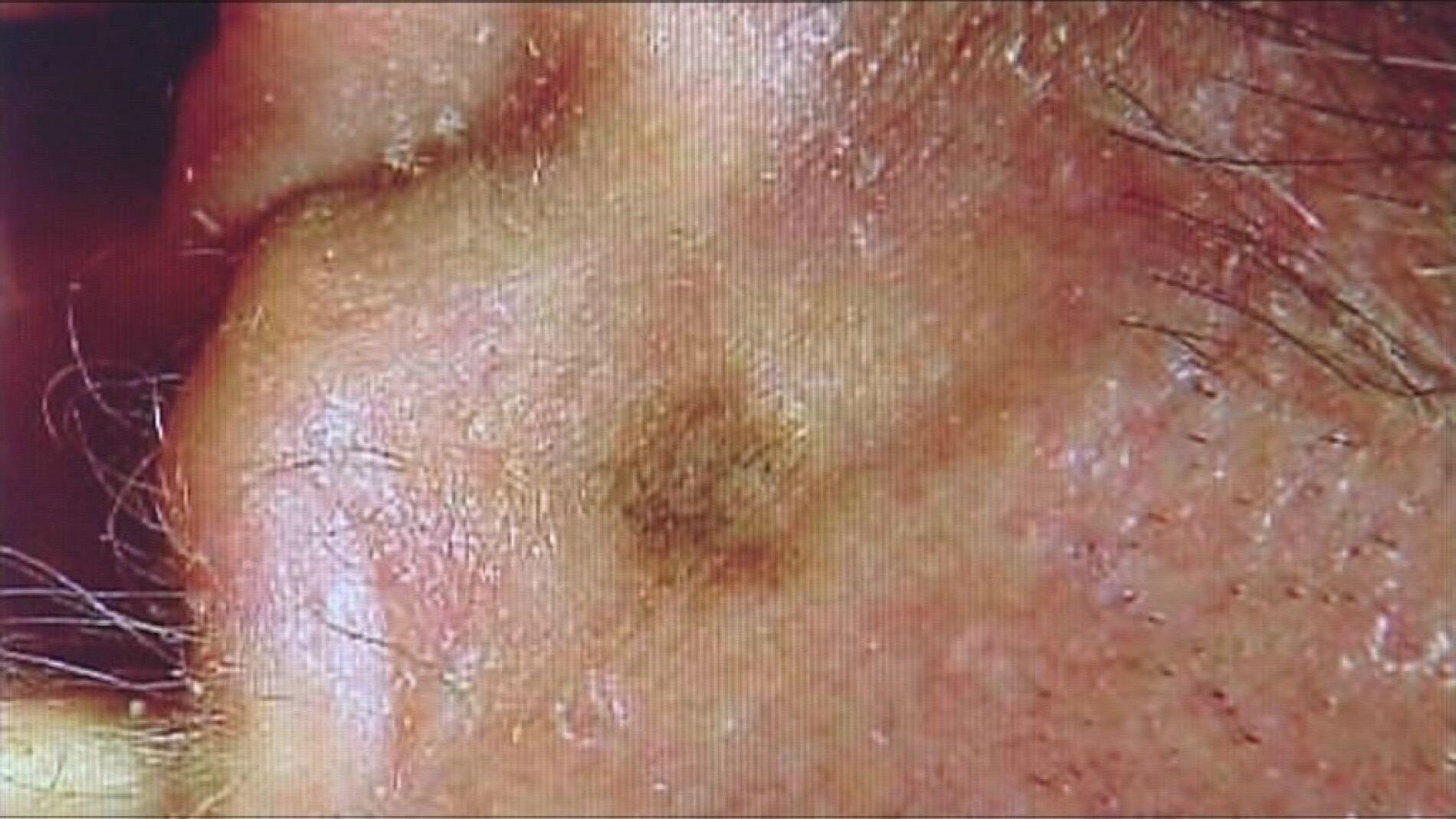 Melanoma