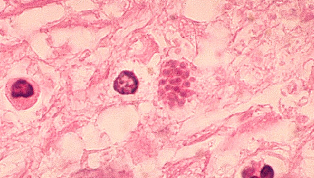 ¿Cómo afectan las infecciones parasitarias a la economía? ¿Cómo afectan las infecciones parasitarias a la economía?