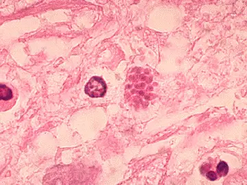 Las enfermedades parasitarias podrían influir en la economía de un país Las enfermedades parasitarias podrían influir en la economía de un país