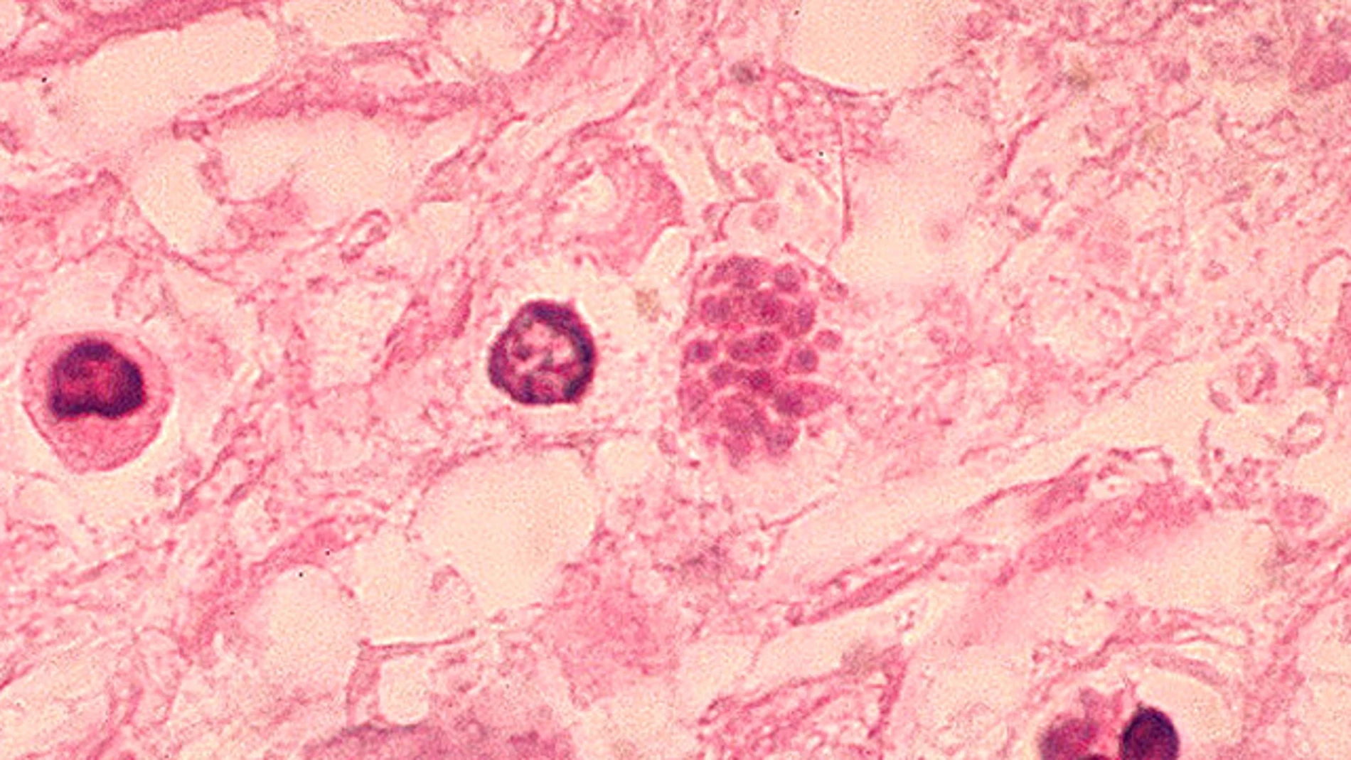 Las enfermedades parasitarias podrían influir en la economía de un país Las enfermedades parasitarias podrían influir en la economía de un país