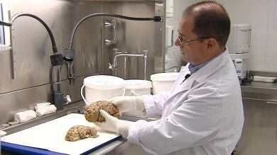 Electrodos implantados en el cerebro podrían tratar la depresión, la anorexia y el alzheimer