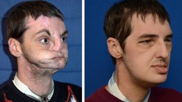 Norris, antes y después del transplamte de cara