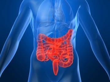 Cáncer de colon Cáncer de colon