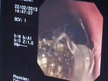 La bola de pelo extraida a Niniu durante su intervención quirúrjica La bola de pelo extraida a Niniu durante su intervención quirúrjica