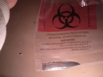La hoja de cuchillo extirpada de la espalda de Bill McNeely La hoja de cuchillo extirpada de la espalda de Bill McNeely