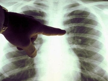 Un oncólogo examina la radiografía de unos pulmones