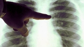 Un oncólogo examina la radiografía de unos pulmones