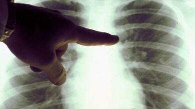 Cada vez hay más mujeres y no fumadores que padecen cáncer de pulmón