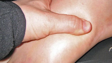 Uno de los síntomas de la gota es el pie hinchado