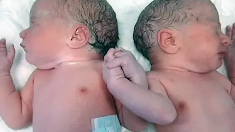 Los mellizos se agarran nada más nacer Los mellizos se agarran nada más nacer