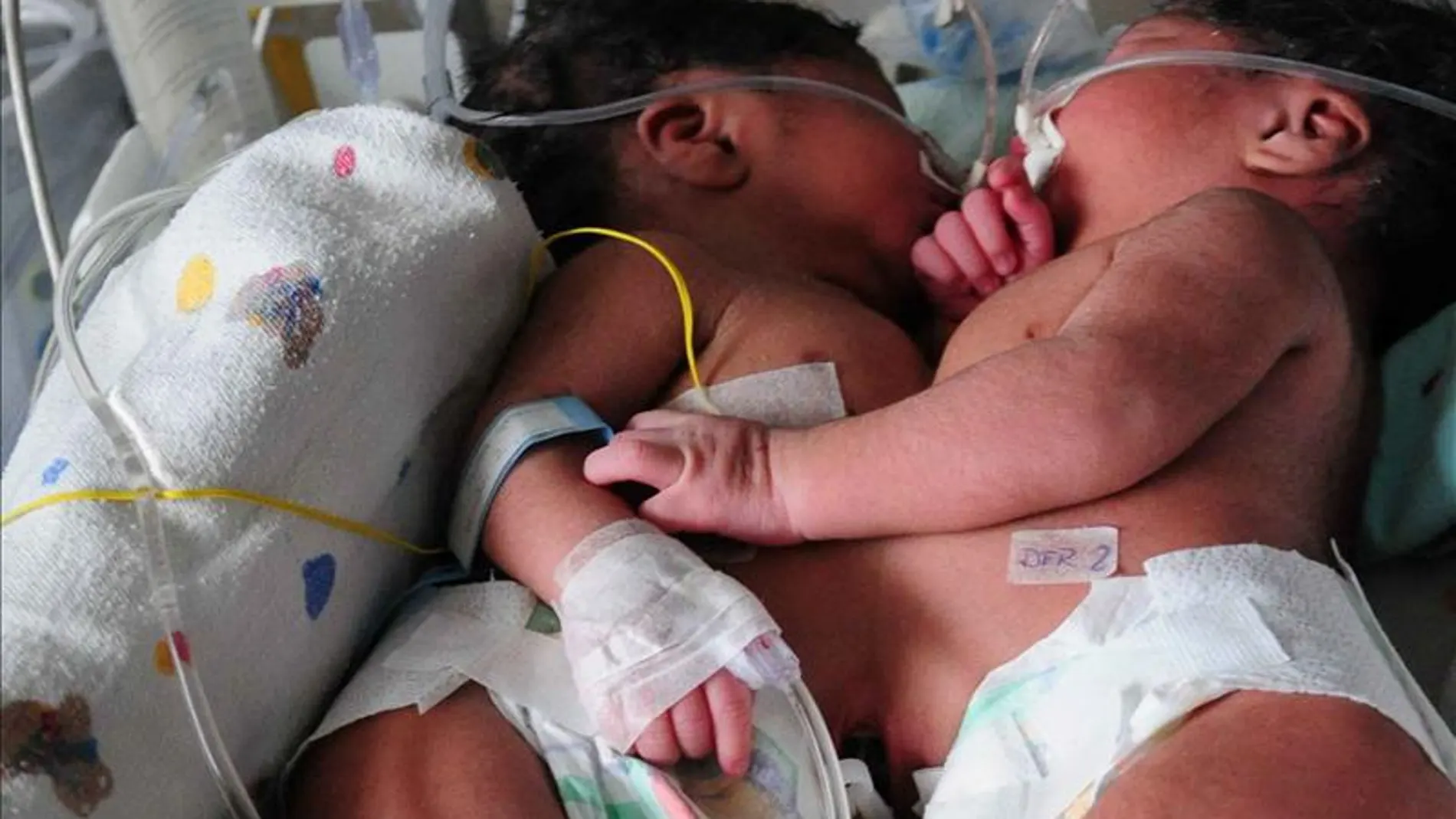 Una joven boliviana dio a luz a siamesas unidas por el abdomen Una joven boliviana dio a luz a siamesas unidas por el abdomen